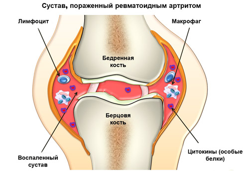 поражение сустава ревматоидным артритом