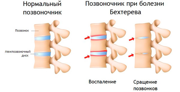 здоровый позвоночник и при артрите Бехтерева