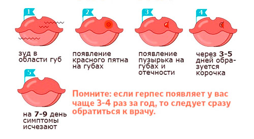 стадии развития герпеса на губах