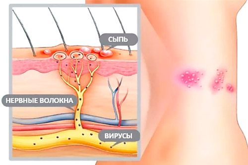 схема поражения кожи вирусом герпеса