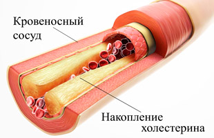 сосуд с холестерином в разрезе