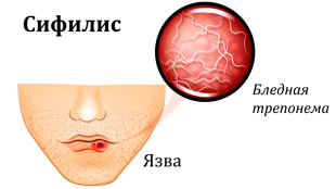 бледная трепонема возбудитель сифилиса