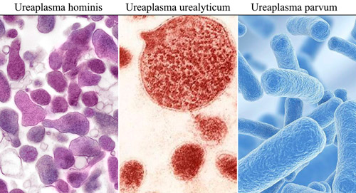 разновидности уреаплазм у человека