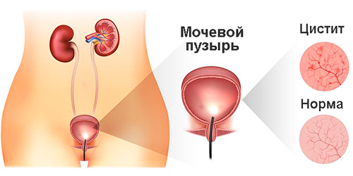 ткани здорового мочевого пузыря и при воспалении