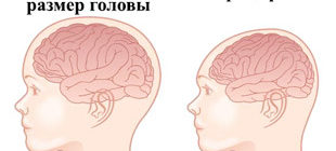 размер головы у здорового ребенка и при микроцефалии