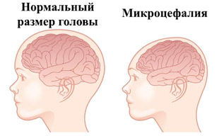 размер головы у здорового ребенка и при микроцефалии