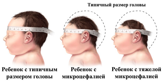 окружность головы у здорового ребенка и с микроцефалией