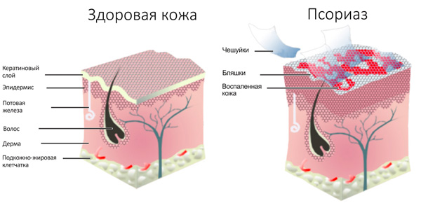 здоровая кожа и псориаз