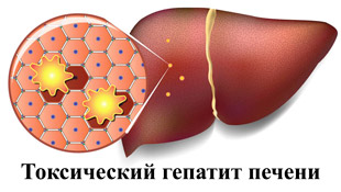 Токсический гепатит печени