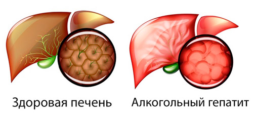 клетки здоровой печени и при алкогольном гепатите