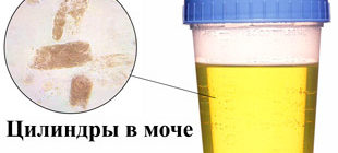 Цилиндры в моче под микроскопом