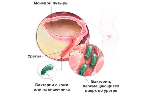 возникновение цистите в результате распространения бактерий