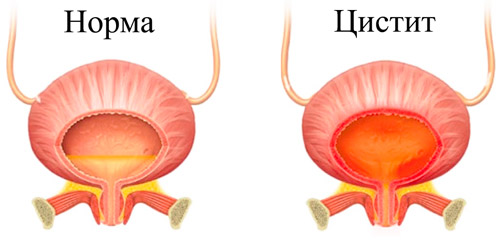 мочевой пузырь в норме и при цистите