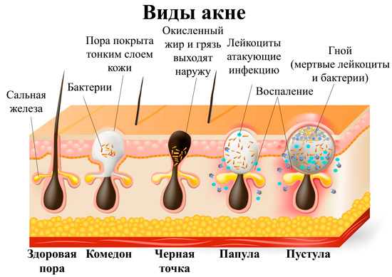 схема образования акне