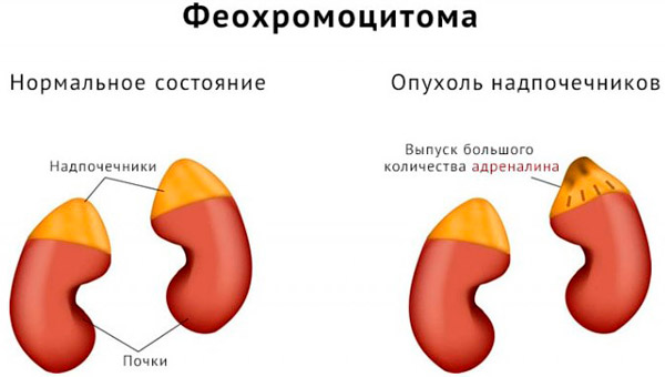 феохромоцитома в надпочечниках