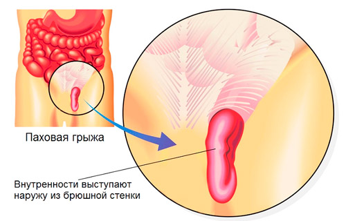 образование паховой грыжи