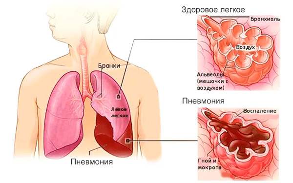 здоровые легкие и воспаление легких