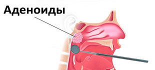 аденоиды 3 степени