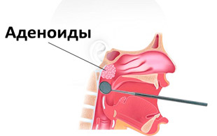 аденоиды 3 степени