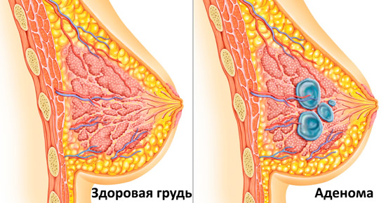 здоровая грудь и аденома 