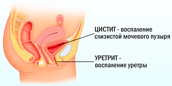 уретрит и цистит