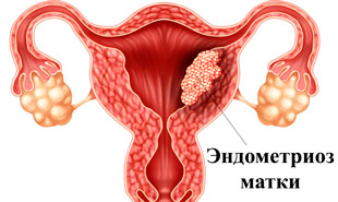 Эндометриоз матки