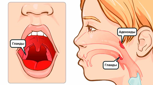 расположение аденоидов в носоглотке