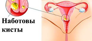 Наботовы кисты шейки матки