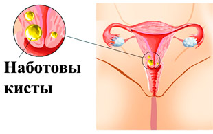 Наботовы кисты шейки матки