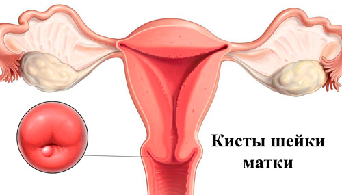Кисты шейки матки