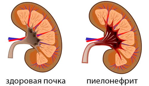 здоровая почка и пиелонефрит