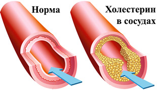 нормальный сосуд и с холестерином