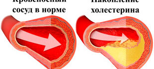 здоровый сосуд и накопление холестерина