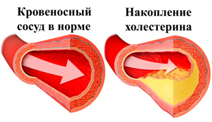 здоровый сосуд и накопление холестерина