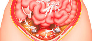 спайки в малом тазу