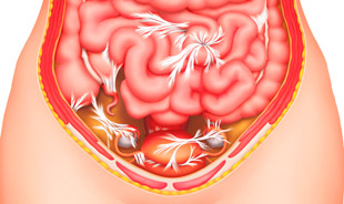 спайки в малом тазу