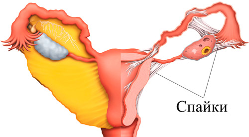 спайки в маточных трубах