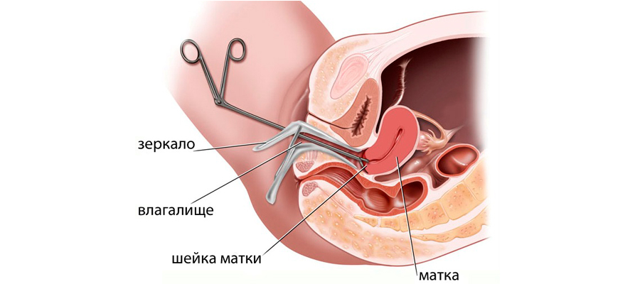 биопсия шейки матки